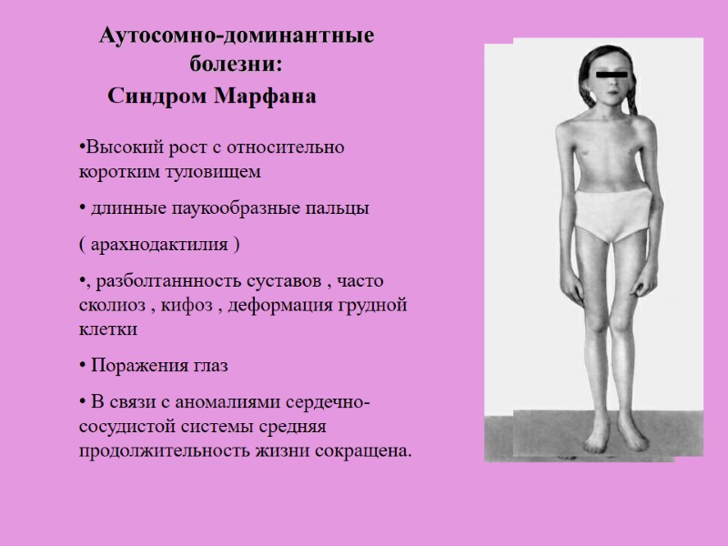 Синдром Марфана Высокий рост с относительно коротким туловищем   длинные паукообразные пальцы (